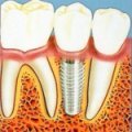 Насколько необходимо протезирование при отсутствии зуба?