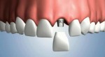 Опасны ли зубные импланты?