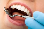 Зубной камень: причины и методы борьбы